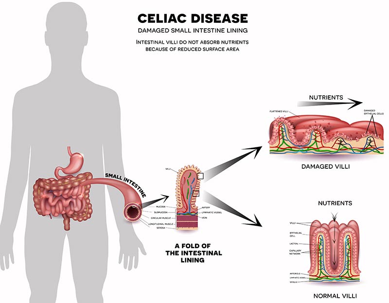 Celiac Disease - Digestive Nutrition Clinic